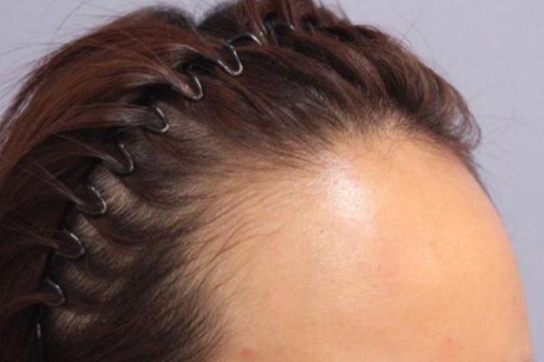 如何使发际线前移,怎样才能让发际线往前移