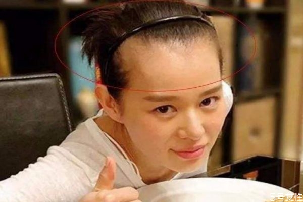 发际线后移怎么办能恢复吗,发际线后移怎么办女生怎么改善