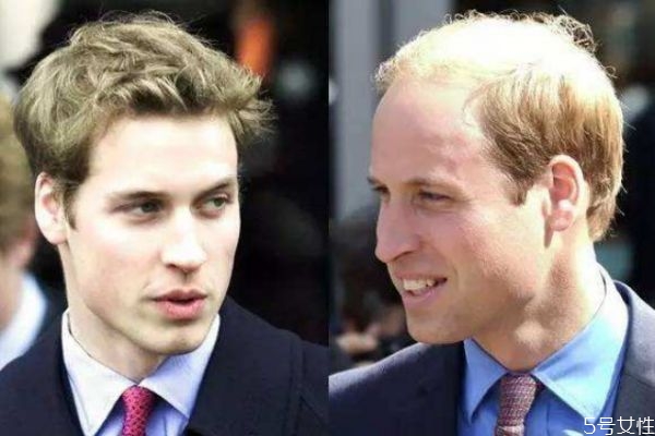 如何修饰发际线,发际线不好看怎么办