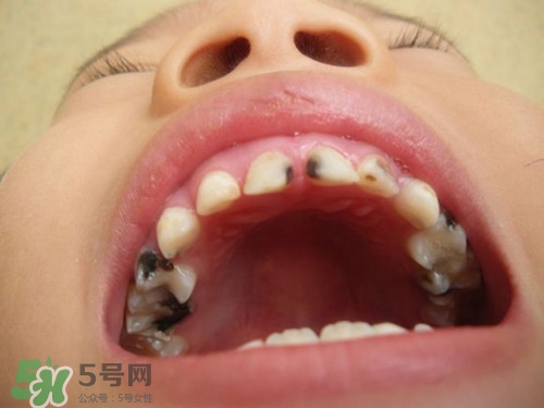 儿童换牙长不出来是怎么回事,小孩换牙为什么不长新牙了