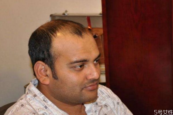 植发后会掉发吗,植发会不会再掉