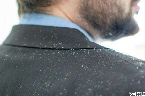 用什么可以去除头皮屑,怎么可以有效的去除头皮屑