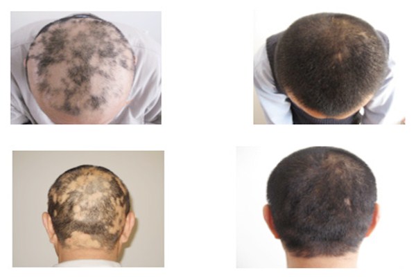 斑秃的脱发为,斑秃脱发严重的原因是什么