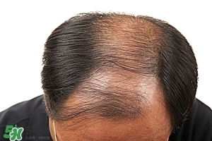 头皮脱发严重的原因是什么,头发脱落的很厉害是什么原因