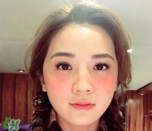 点痣之前需要注意什么,点痣前需要注意什么