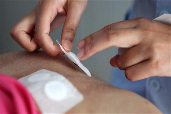 三伏贴起泡说明身体什么问题,贴三伏贴起泡怎么处理