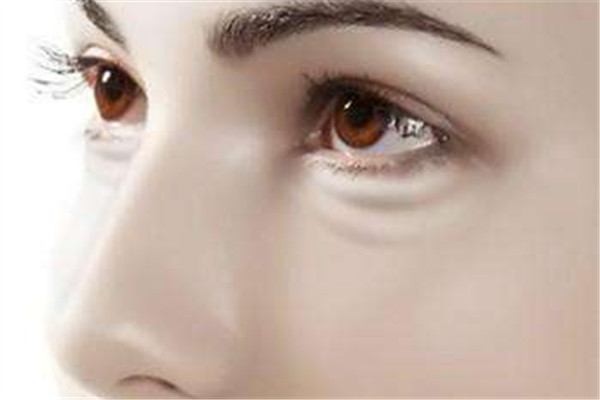 黑眼圈类型怎么区分,黑眼圈类型图解