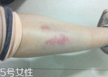 摔伤了用什么消毒水比较好,摔伤了怎么消毒 摔伤了用什么消毒水比较好,摔伤了怎么消毒