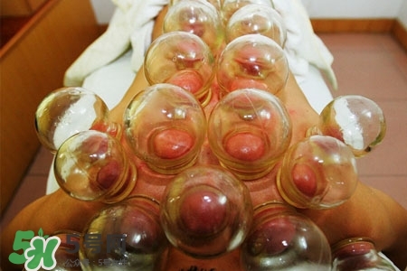 放血拔罐治疗银屑病吗,中医放血拔罐治银屑病 放血拔罐治疗银屑病吗,中医放血拔罐治银屑病