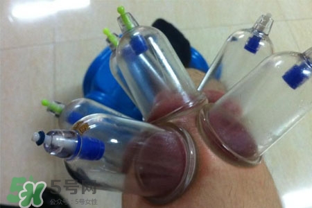 腿上拔火罐的好处,小腿能拔火罐吗