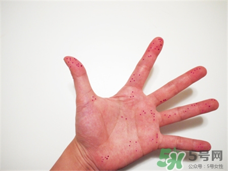 切辣椒手辣怎么办最有效的方法,辣椒辣手了怎么处理