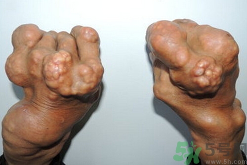 痛风的饮食治疗及注意事项,痛风患者饮食大全