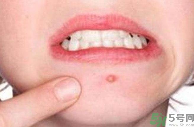 哪里痘痘不能挤,哪些地方的痘痘不能挤