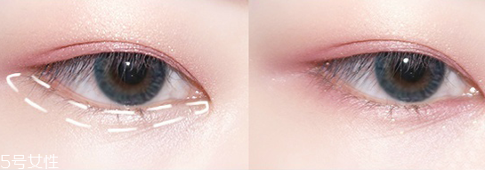 红蓝光祛痘的注意事项(红蓝光祛痘的注意事项)