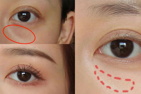 抽脂溶脂的区别：适用部位不同(溶脂和抽脂有什么不同)