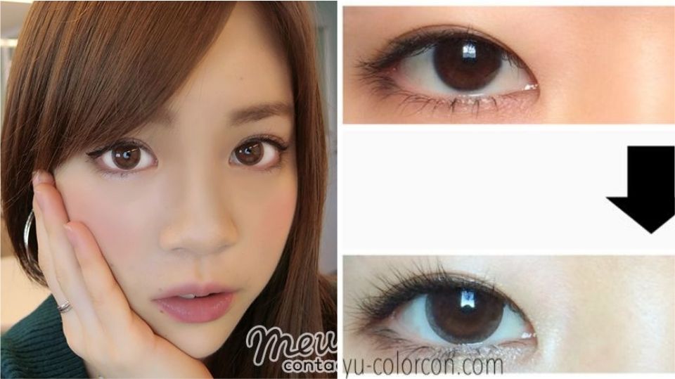 硅胶假体丰额的副作用(假体丰额头硅胶好还是膨体)