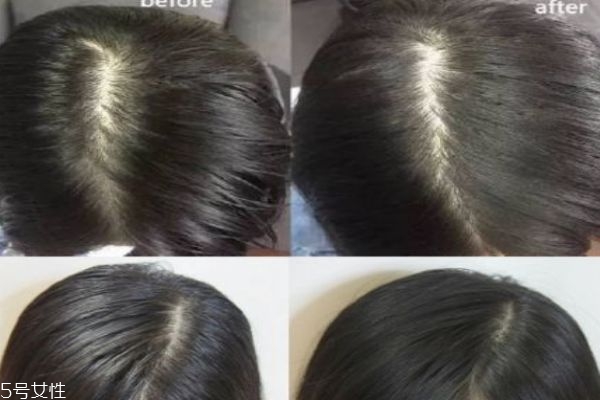 拔火罐减肥会反弹吗(拔罐减肥会反弹吗)