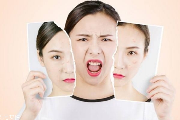 心情会不会影响长痘痘,痘痘和心情有关系吗 心情会不会影响长痘痘,痘痘和心情有关系吗