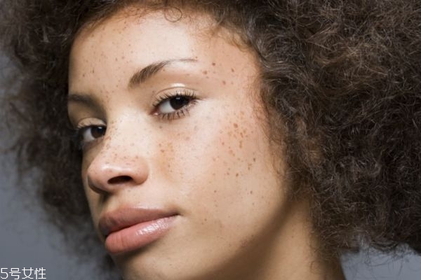 脸上长斑是怎么形成的,脸上的斑是怎么形成的?有几种原因?