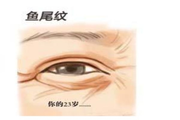人为什么会长鱼尾纹,鱼尾纹产生原因 人为什么会长鱼尾纹,鱼尾纹产生原因