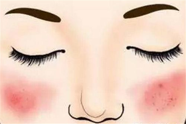 怎样消除红血丝的方法,去红血丝的偏方大全