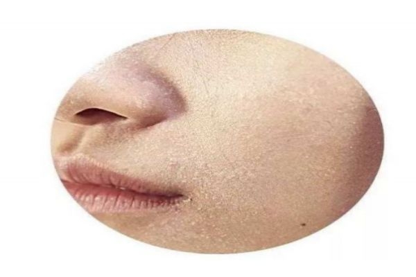 干皮如何护肤,干皮怎样护理皮肤 干皮如何护肤,干皮怎样护理皮肤