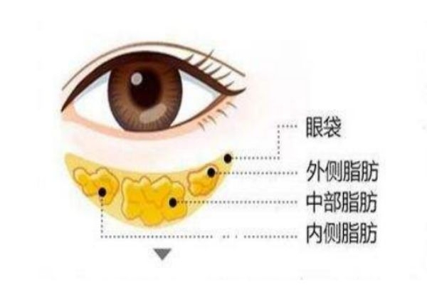 眼袋是怎么形成的原因是什么,眼袋是怎样形成的