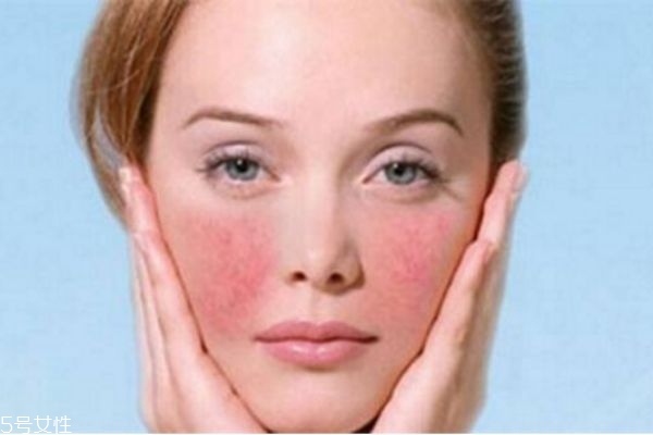 洋甘菊可以去红血丝吗,洋甘菊去红血丝吗?