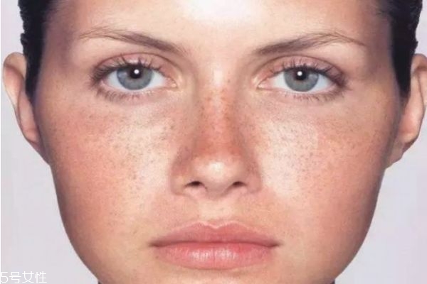 色斑是怎么形成的原因,色斑怎么形成的原因分析
