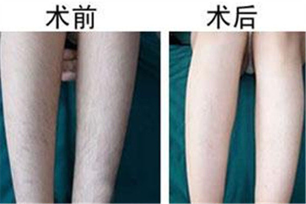 汗毛越来越多怎么回事,女生汗毛多怎么办,怎样除掉