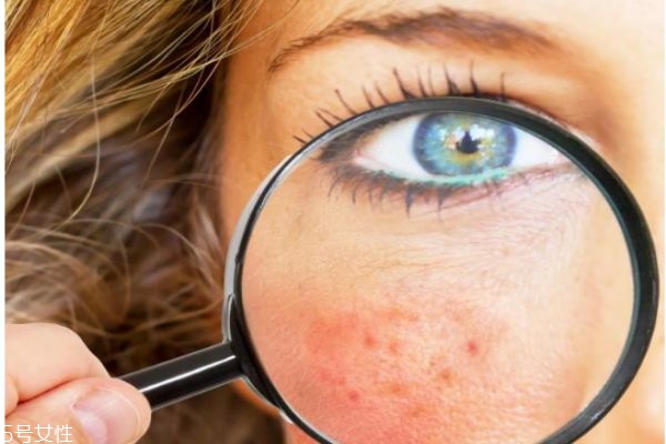 脸上经常去角质好不好,脸要经常去角质吗