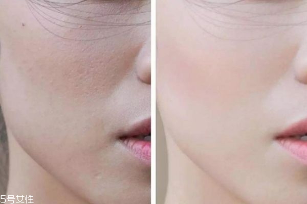 男生脸部皮肤粗糙毛孔大怎么改善,脸部皮肤粗糙毛孔大怎么改善 男生脸部皮肤粗糙毛孔大怎么改善,脸部皮肤粗糙毛孔大怎么改善