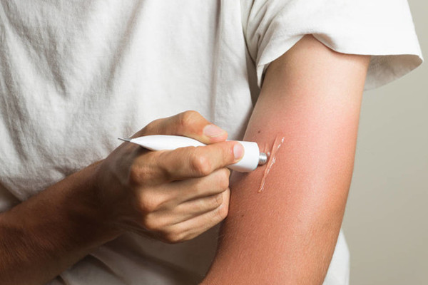 晒伤后脱皮怎么办,晒伤后脱皮可以撕掉吗