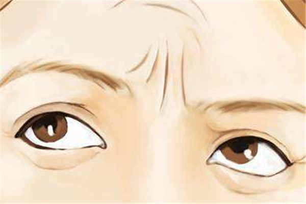 出现川字纹的原因,川字纹是什么原因造成的?