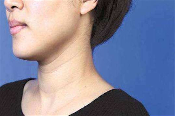 怎样消除颈纹,如何消除颈纹最有效的方法
