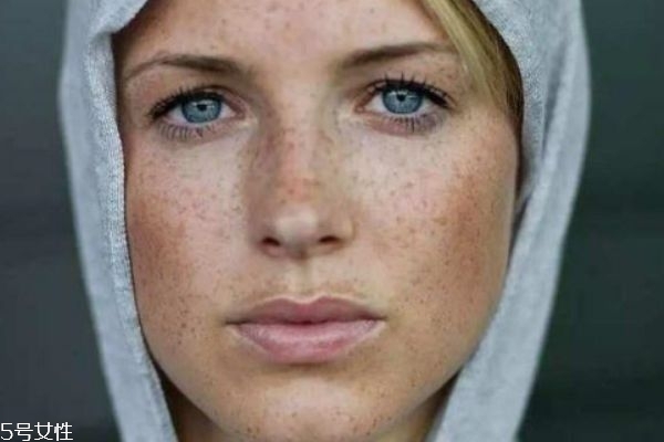 怎么区分斑和痣,痣和斑的区别