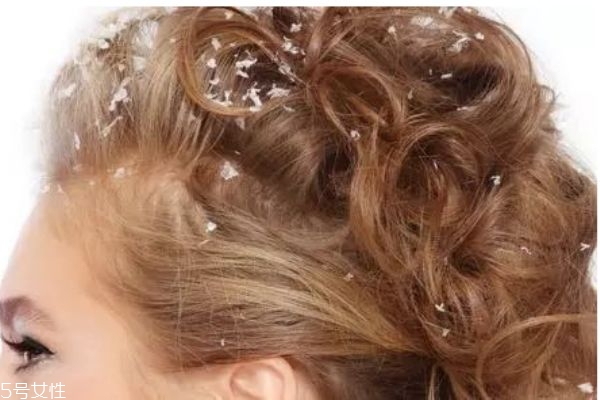 头皮屑太多了该怎么办,头皮屑特别多怎么解决