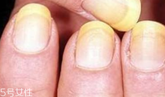 指甲变黄怎么处理方法,指甲发黄怎么办