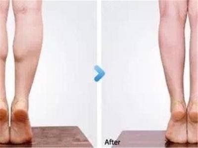 大象腿会遗传吗,遗传大象腿还有救吗 大象腿会遗传吗,遗传大象腿还有救吗