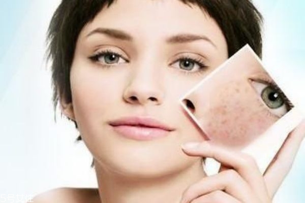 如何治疗痤疮最有效,痤疮怎么样才能彻底治好