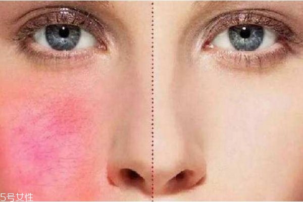 红血丝该如何治疗,红血丝要怎样治疗