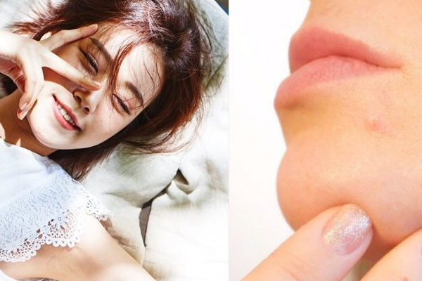 怎么让脸不长痘,怎么避免脸上长痘 怎么让脸不长痘,怎么避免脸上长痘