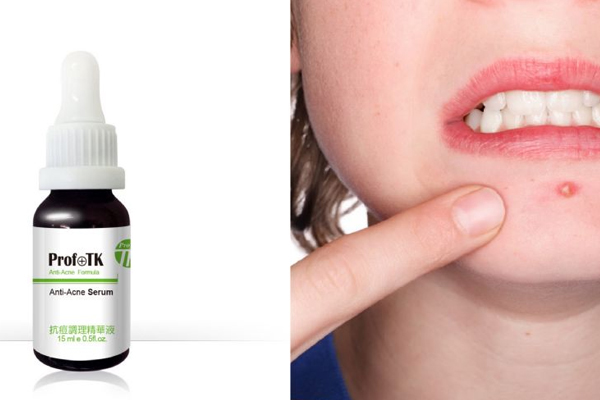 好用的祛痘精华推荐,口碑最好十大祛痘精华液 好用的祛痘精华推荐,口碑最好十大祛痘精华液