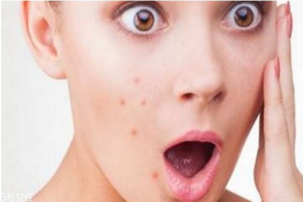 熬夜会起痘痘么,熬夜起痘痘怎么回事 熬夜会起痘痘么,熬夜起痘痘怎么回事