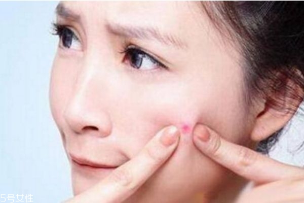 经常熬夜脸上长粉刺怎么处理,熬夜导致脸上长痘痘怎么办 经常熬夜脸上长粉刺怎么处理,熬夜导致脸上长痘痘怎么办