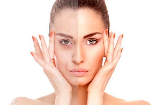 怎么才能确定是不是激素脸,怎么看皮肤是不是激素脸