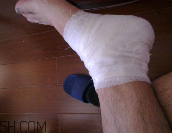 脚踝扭伤怎么办恢复快,脚踝扭伤怎么办快速止痛