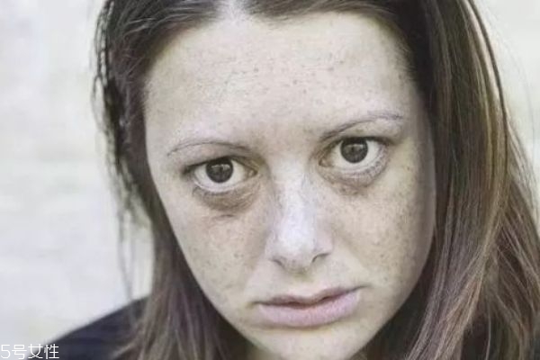 长期熬夜长痘痘怎么调理,上夜班长痘痘怎么调理