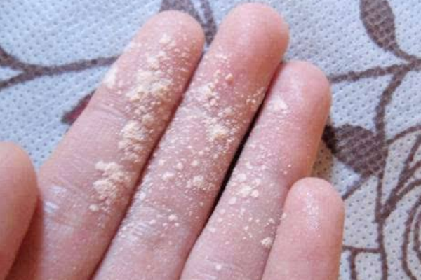 秋冬浮粉怎么办,冬天浮粉怎么办