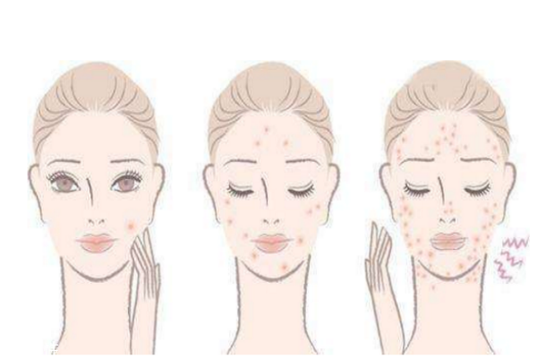 怎么去痘印最有效的方法有哪些,什么方法去痘印最快